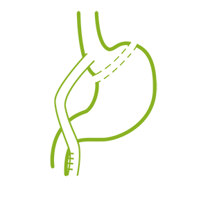 gastric-bypass