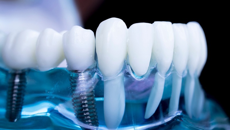 Dental implant cost guide